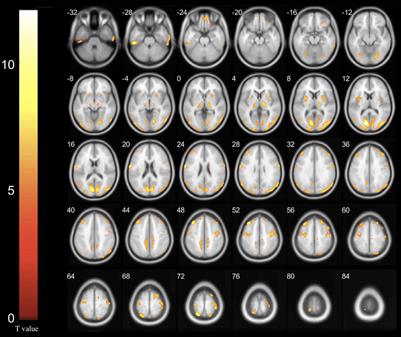 Metabolic Imaging of Deep Brain Stimulation in Meige Syndrome